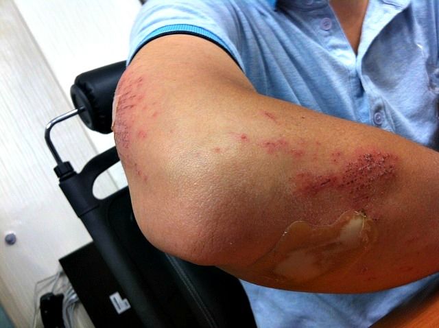 рука травмы